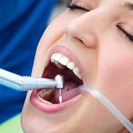 Tooth Scaling
