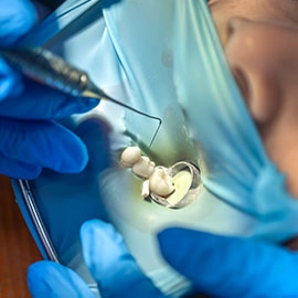 Tooth Extraction